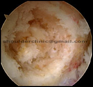Large-cyst